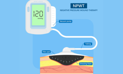 Basics of negative pressure wound therapy (NPWT): Part 1