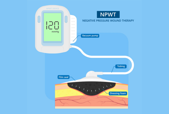 Basics of negative pressure wound therapy (NPWT): Part 1