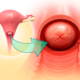 Cervical motion tenderness