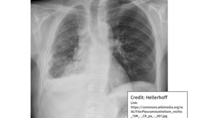 Detection of tracheal deviation