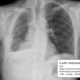 Detection of tracheal deviation