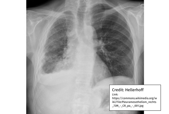 Detection of tracheal deviation