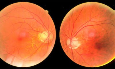 Focusing on abnormal fundus examination results