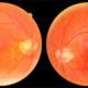 Focusing on abnormal fundus examination results