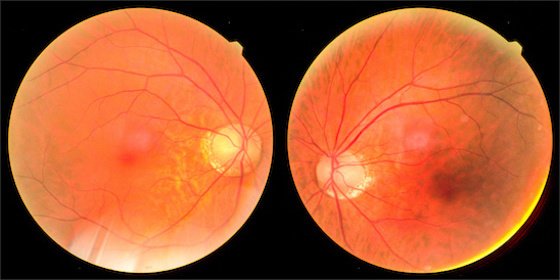 Focusing on abnormal fundus examination results