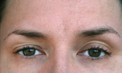 Indication of ptosis