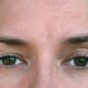 Indication of ptosis