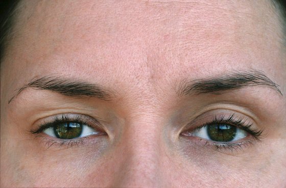 Indication of ptosis