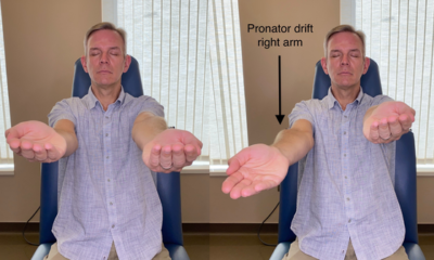 What is pronator drift?