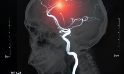 Is there a link between COVID-19 and the risk of stroke?