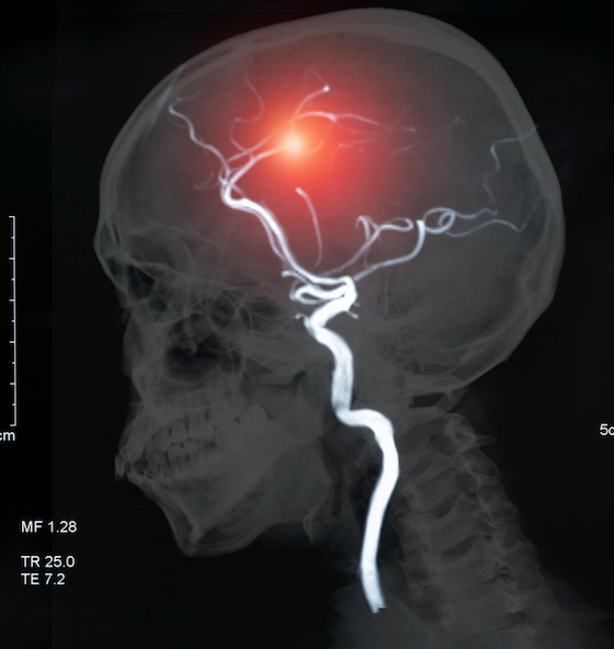 Is there a link between COVID-19 and the risk of stroke?