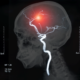 Is there a link between COVID-19 and the risk of stroke?