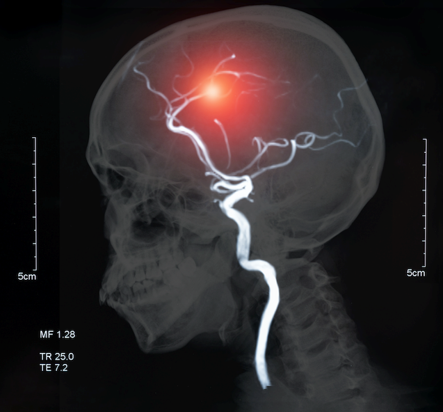 Is there a link between COVID-19 and the risk of stroke?