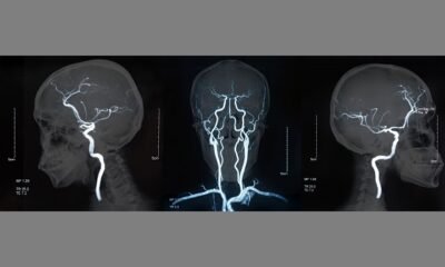 Calculation of cerebral perfusion pressure