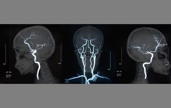 Calculation of cerebral perfusion pressure