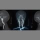 Calculation of cerebral perfusion pressure