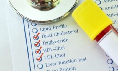 HDL vs. LDL Cholesterol: Understanding Your Lipid Profile