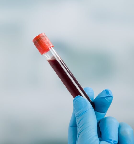 Laboratory Values ​​and Diabetic Ketoacidosis (DKA)